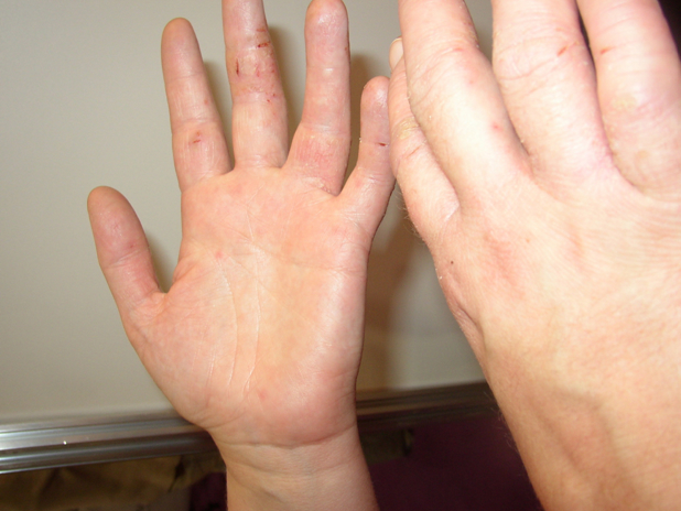 Irritant contact dermatitis from excess washing