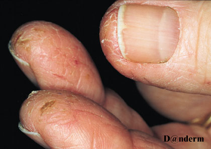 Allergic contact dermatitis from garlic