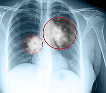 X-ray of lung scarring