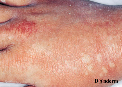 Contact urticaria from latex gloves